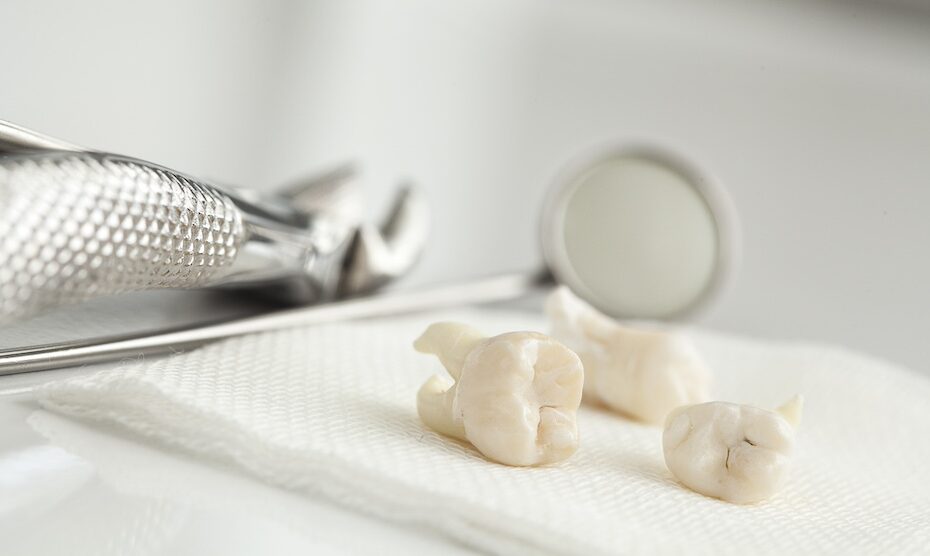 Studie ger klarhet om blodförtunnande medicin vid tandborttagning